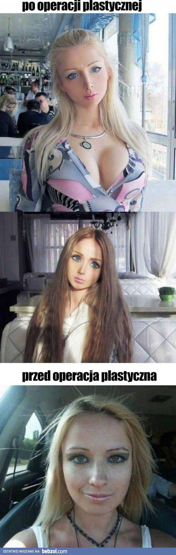 Przed i po operacji plastycznej