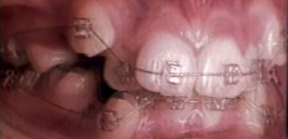Tak aparat ortodontyczny zmienia uzębienie - 60 sekund