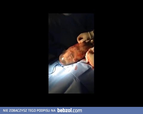 Dziecko przyszło na świat w worku owodniowym