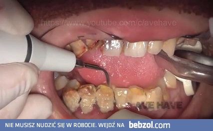 Usuwanie płytki/kamienia nazębnego