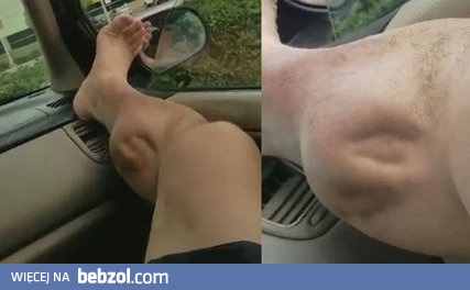 Jak wygląda skurcz mięśni nogi?