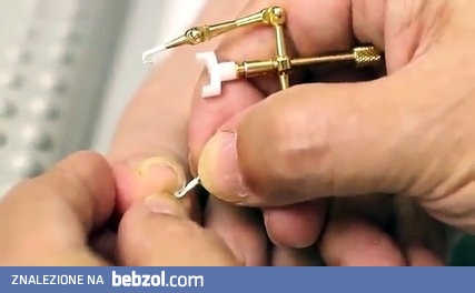 Japońska metoda prostowania wrastającego paznokcia