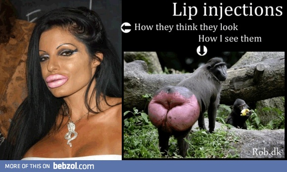 Every time I see someone who has gotten lip injections...