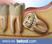 Ząb mądrości?