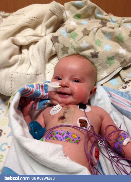 Uśmiech 10 tygodniowego dziecka po operacji na serce