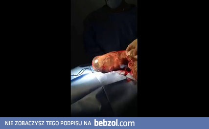 Dziecko urodziło się w nienaruszonym woreczku owodniowym