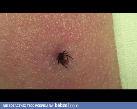 Jak wyciągnąć kleszcza