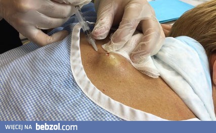 Usuwanie sporej cysty z pleców