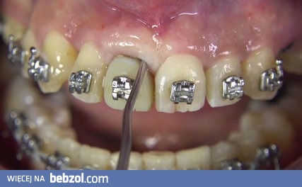 Takie tam nowoczesne wyrywanie zęba